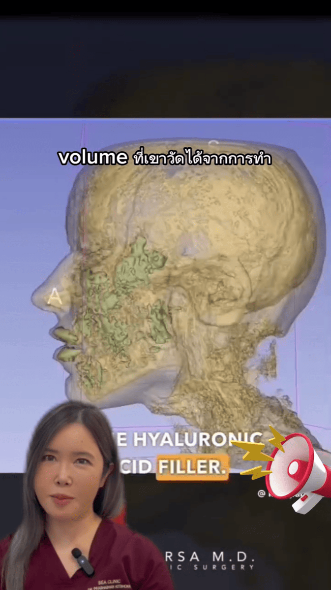 Are Fillers Dangerous Image